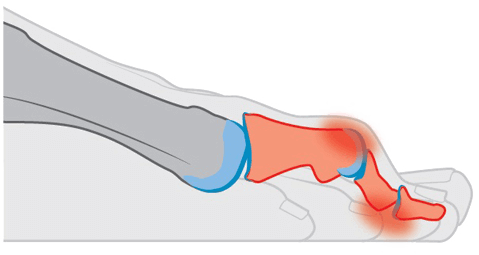 Wat zijn hamertenen? Wat zijn hamertenen?
