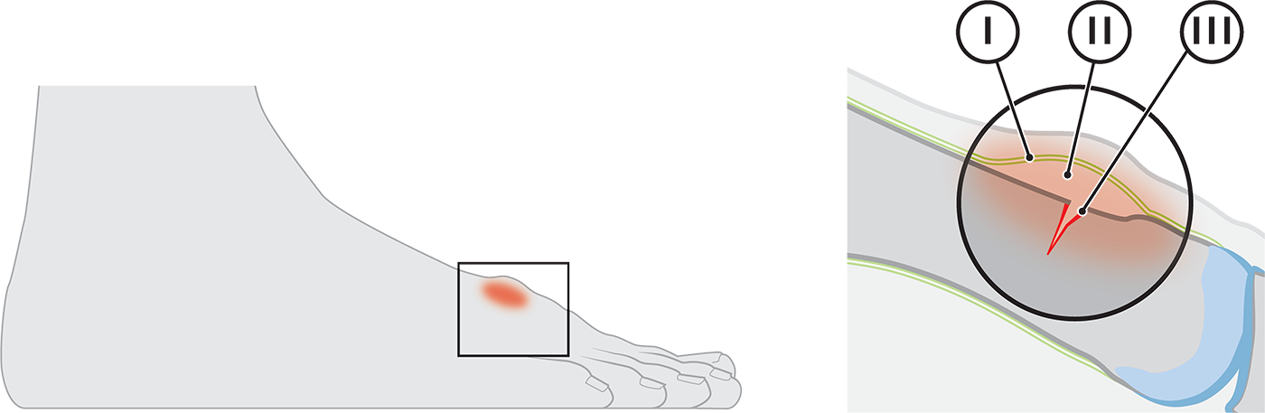 Help! Een vermoeidheidsbreuk! Help! Een vermoeidheidsbreuk!